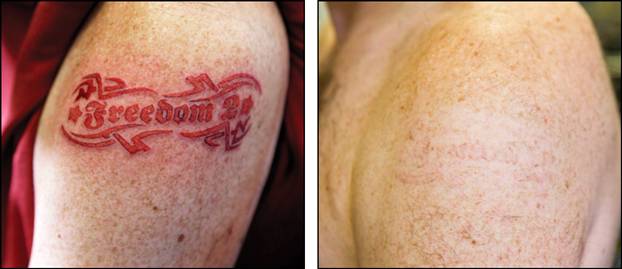 Tattoo Removal Review - Easier Tattoo Removal